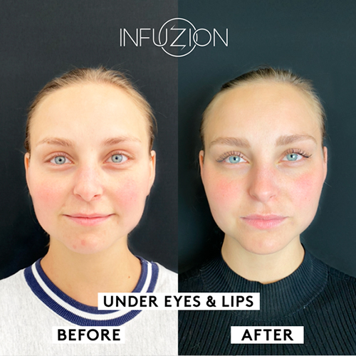 Infuzion t&auml;ytel&auml;ist&auml;v&auml; Volymizer